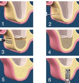 Enxerto ósseo - Levantamento Seio Maxilar (LSM) - Rir Odonto