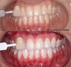 Clareamento - Rir odonto